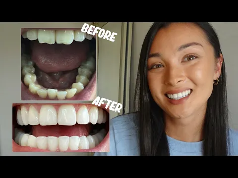 INVISALIGN REVIEW | Before and after pics, Cost, Composite Bonding, Whitening etc.