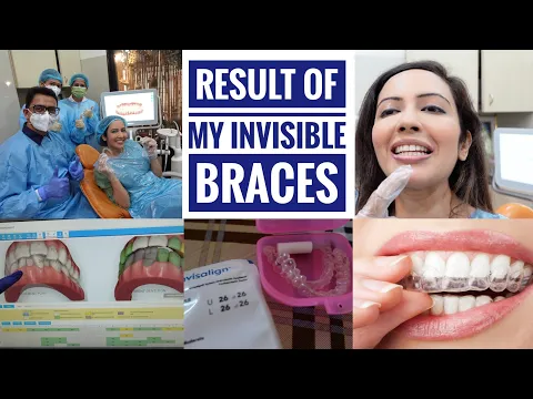 My INVISALIGN Treatment Result🦷 Was This Expensive Process Worth It ???