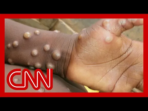 Monkeypox - how does it spread and what are the symptoms?